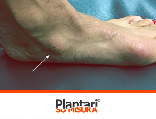 Sindrome dello scafoide accessorio